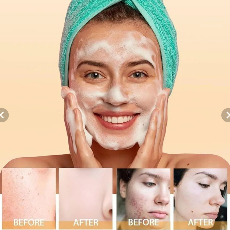 فوم شستشوی صورت ضد آکنه سادور حاوی سالیسیلیک اسید